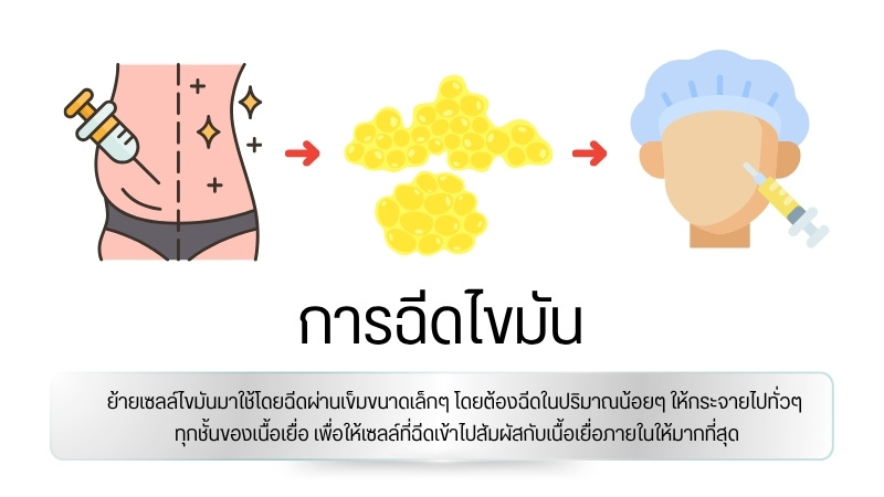 วิธีการฉีดไขมัน
