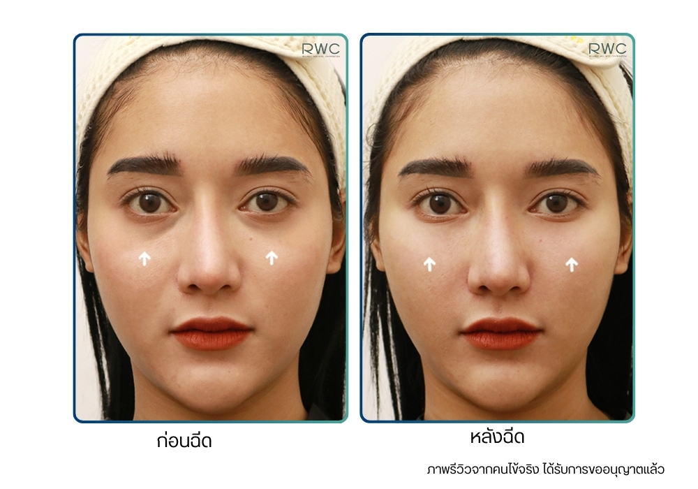 รีวิวก่อน-หลังฉีดใต้ตา Restylane ที่ RWC Clinic
