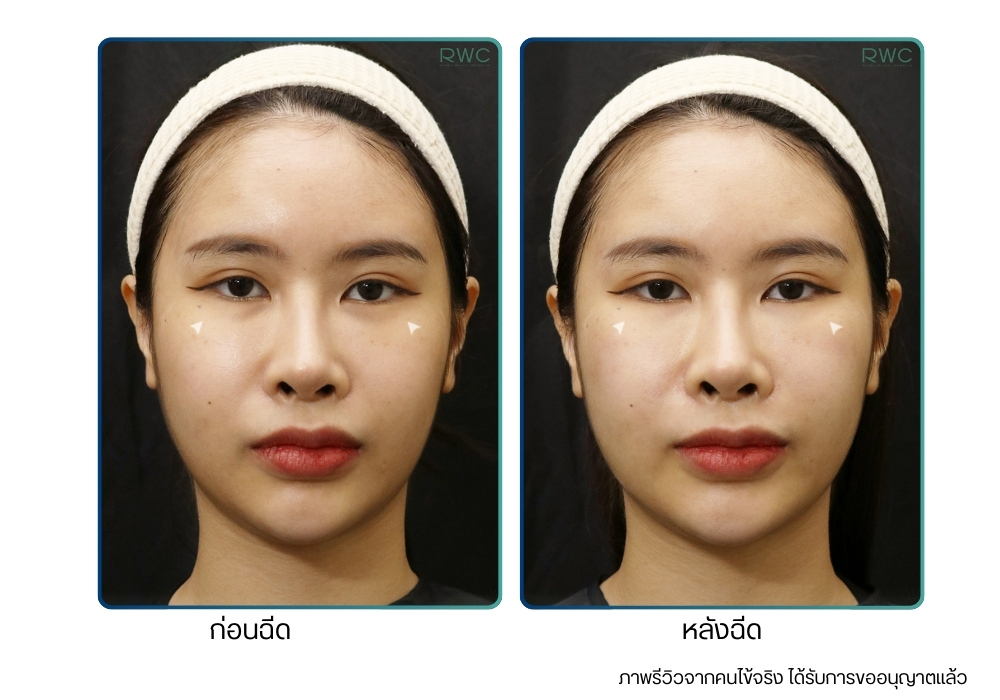 รีวิวก่อน-หลังฉีด ที่ RWC Clinic