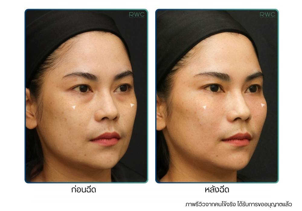รีวิวก่อน-หลังฉีด Restylane