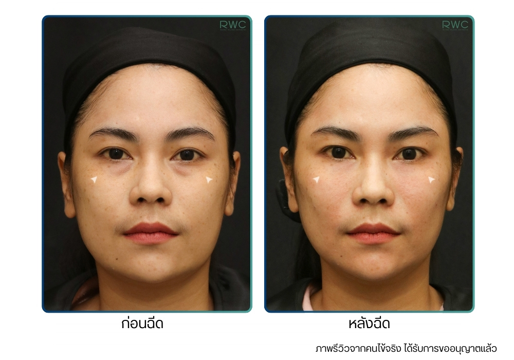 รีวิวก่อน-หลังฉีด Restylane ที่ RWC Clinic