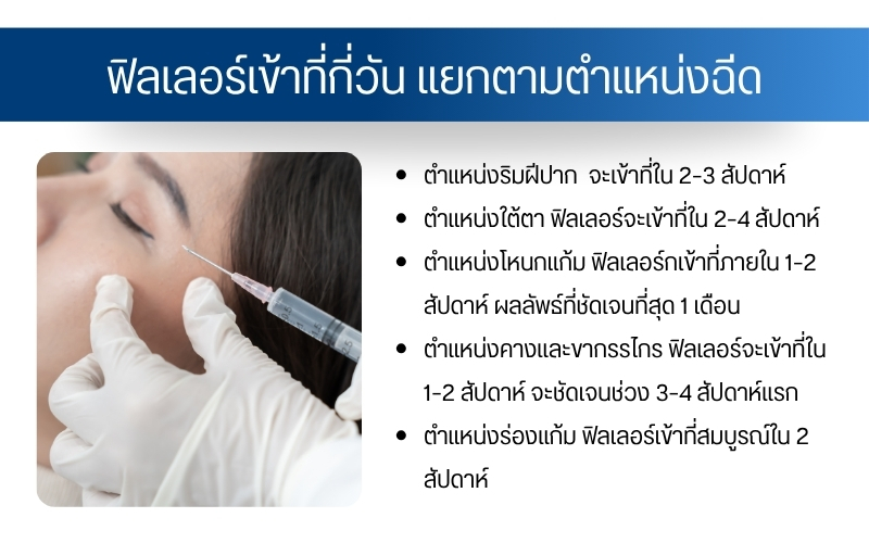 ฟิลเลอร์เข้าที่กี่วัน แยกตามตำแหน่งฉีด
