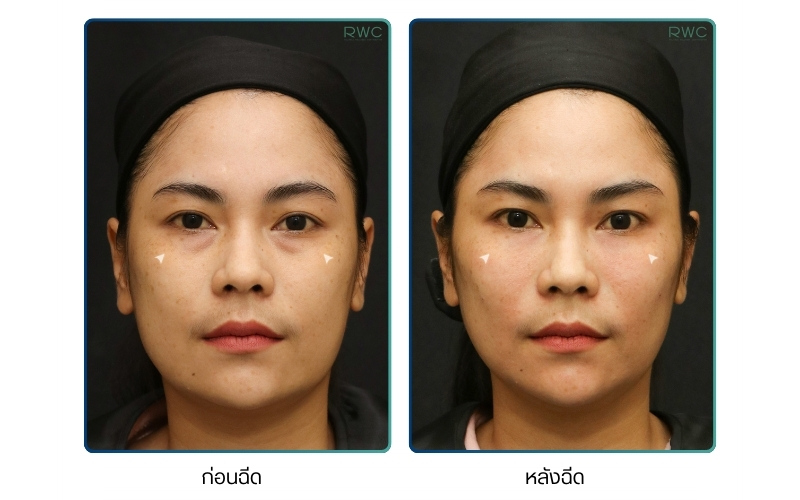 ผลลัพธ์หลังการฉีดรักษาฟิลเลอร์ Juvederm
