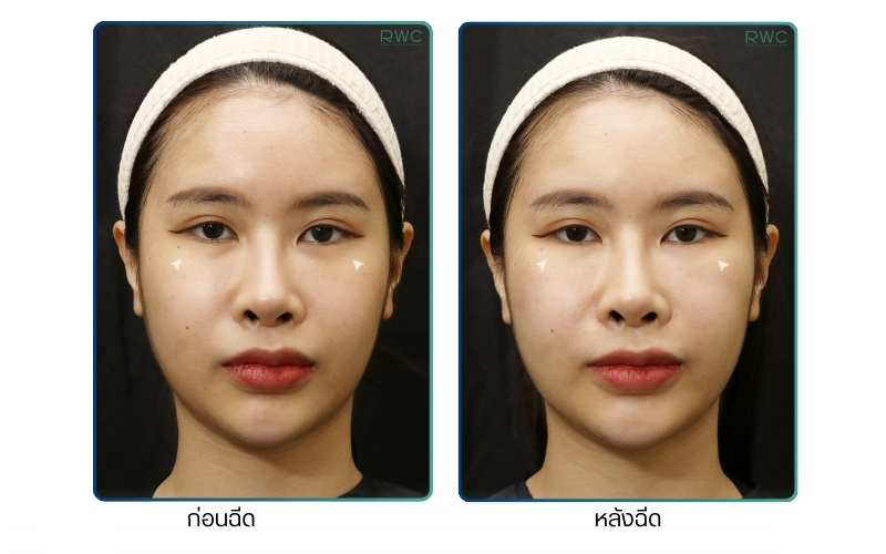 ผลลัพธ์หลังการฉีดรักษาฟิลเลอร์ Juvederm