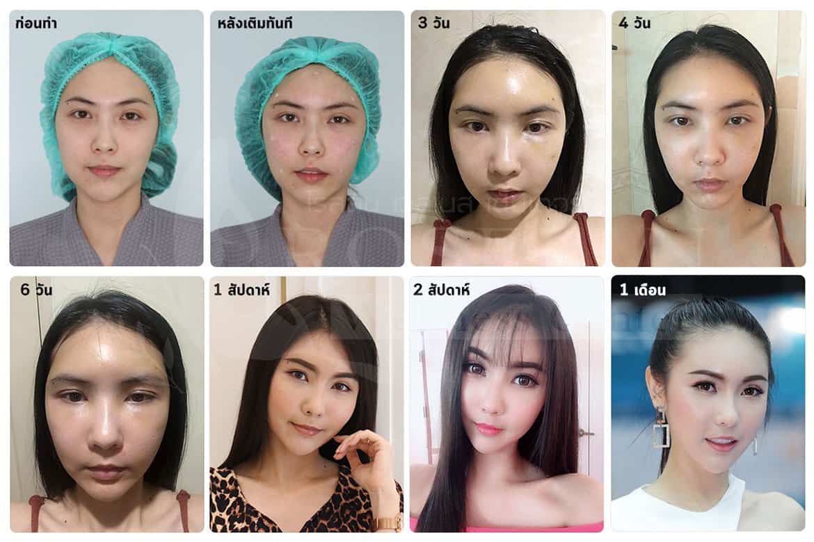 ฉีดไขมัน บวมกี่วัน pantip