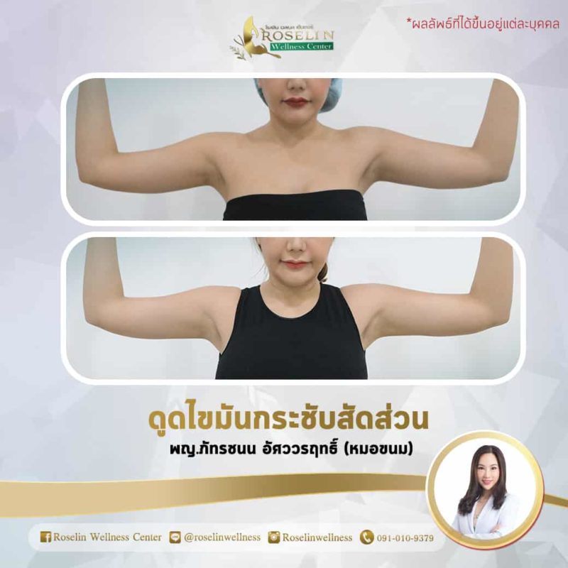 ดูดไขมันกระชับสัดส่วน