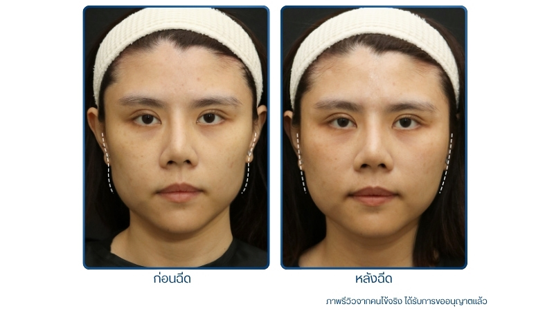 รีวิว ฟิลเลอร์แก้มตอบ