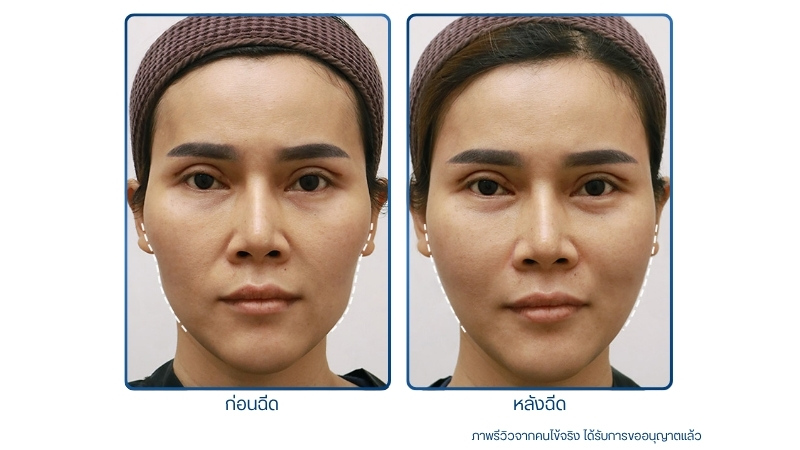 ฉีดฟิลเลอร์แก้มตอบ รีวิว