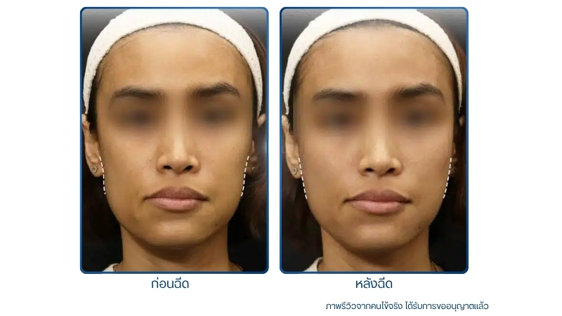 รีวิวฉีดฟิลเลอร์แก้มตอบ