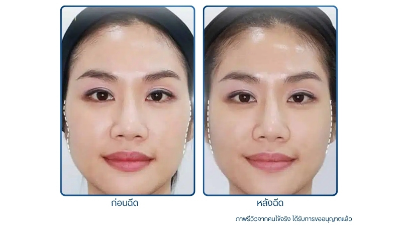 รีวิวแก้มตอบ