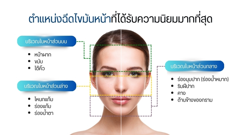 ตำแหน่งฉีดไขมันหน้าที่ได้รับความนิยมมากที่สุด