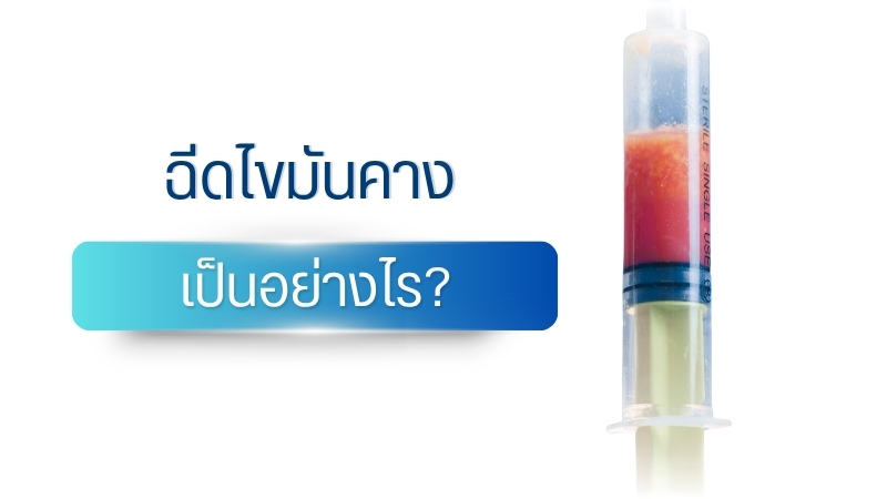 ฉีดไขมันคาง เป็นอย่างไร