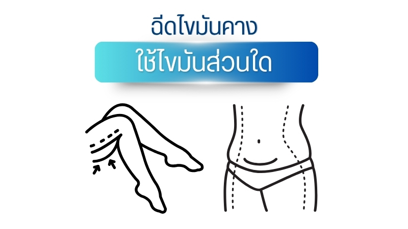 ฉีดไขมันคาง ใช้ไขมันส่วนใดบ้าง