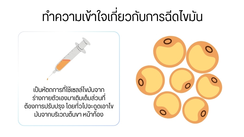 ทำความเข้าใจเกี่ยวกับการฉีดไขมัน