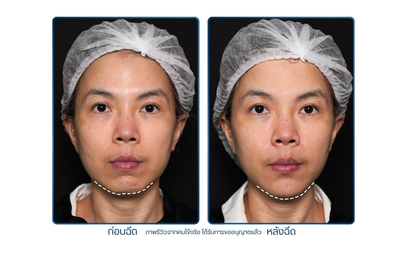 รีวิวฉีดคาง