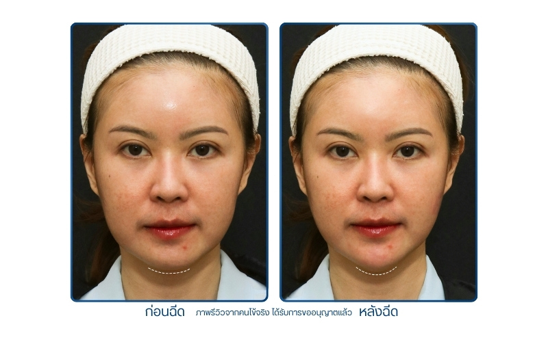 รีวิวคาง