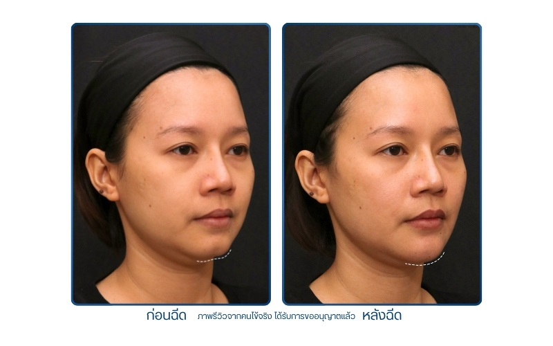 ฉีดฟิลเลอร์คาง รีวิว