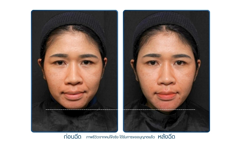 รีวิวฉีดฟิลเลอร์คาง