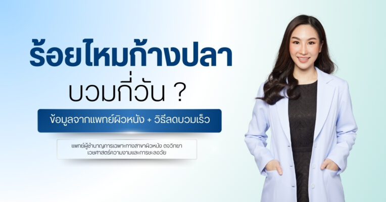 ร้อยไหมก้างปลา บวมกี่วัน