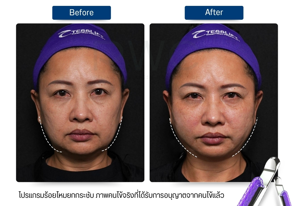 รีวิวการร้อยไหมที่ Rwc clinic