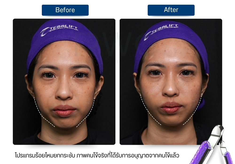 รีวิว ก่อน-หลัง ร้อยไหมที่ Rwc clinic