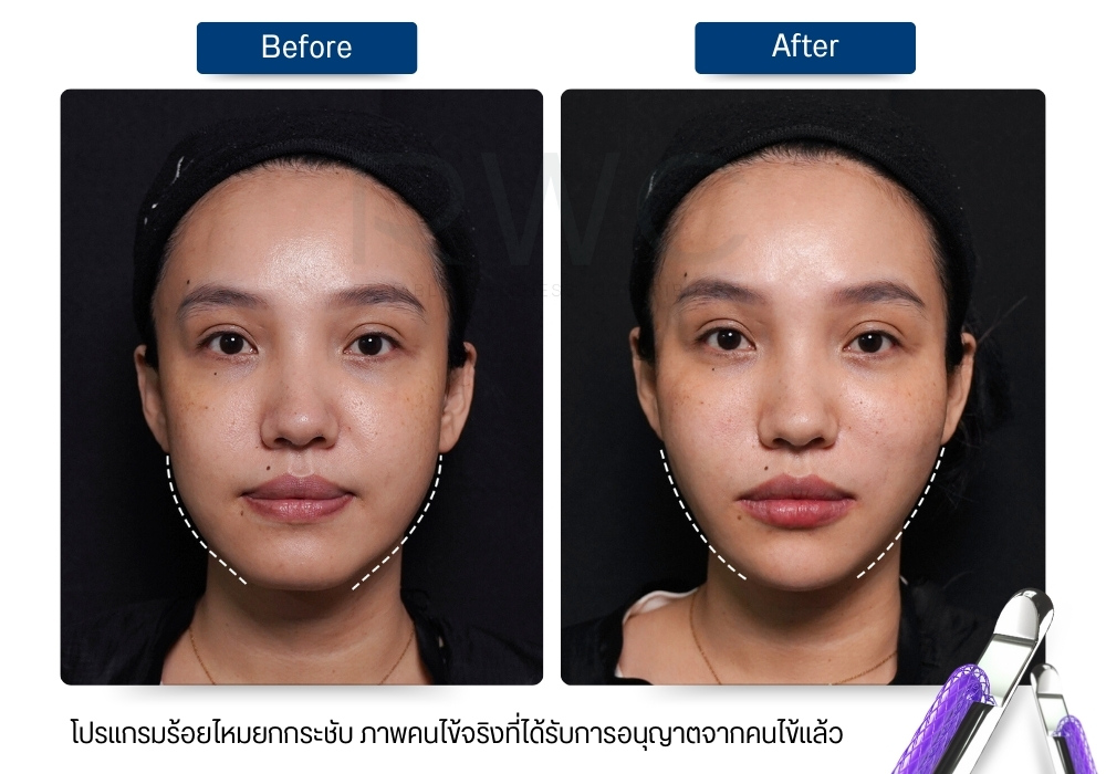 รีวิว ร้อยไหมที่ Rwc clinic