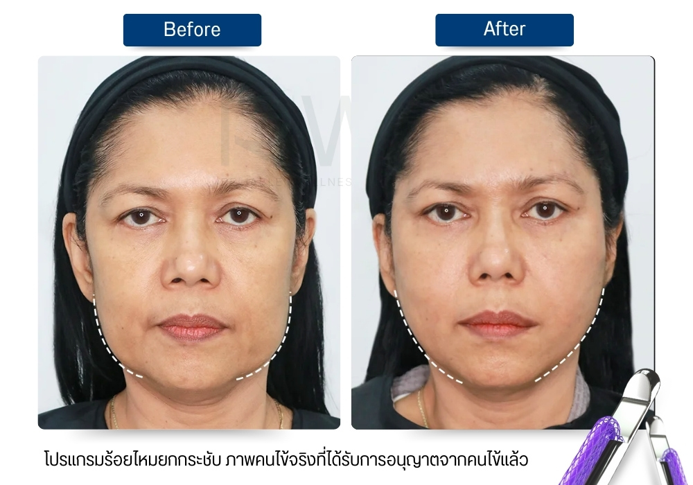 รีวิว ร้อยไหม