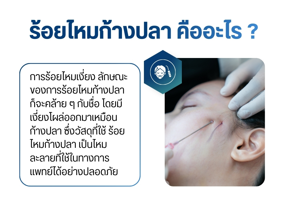 ร้อยไหมก้างปลา คืออะไร