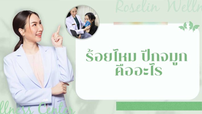 ร้อยไหม ปีกจมูก