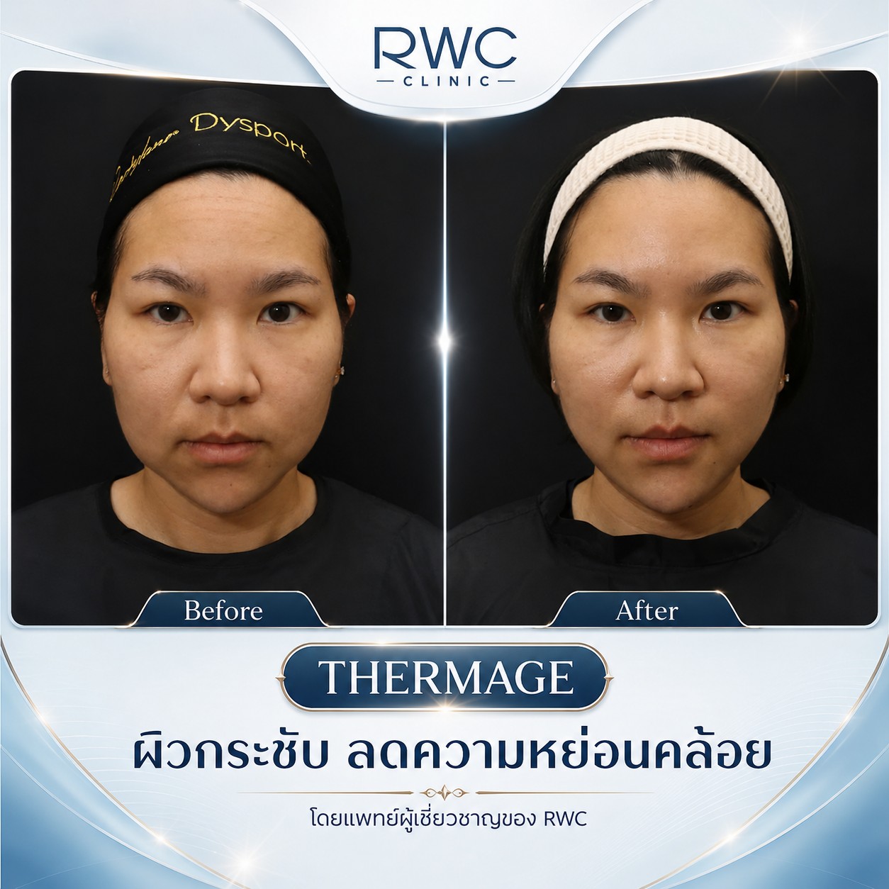 Thermage review