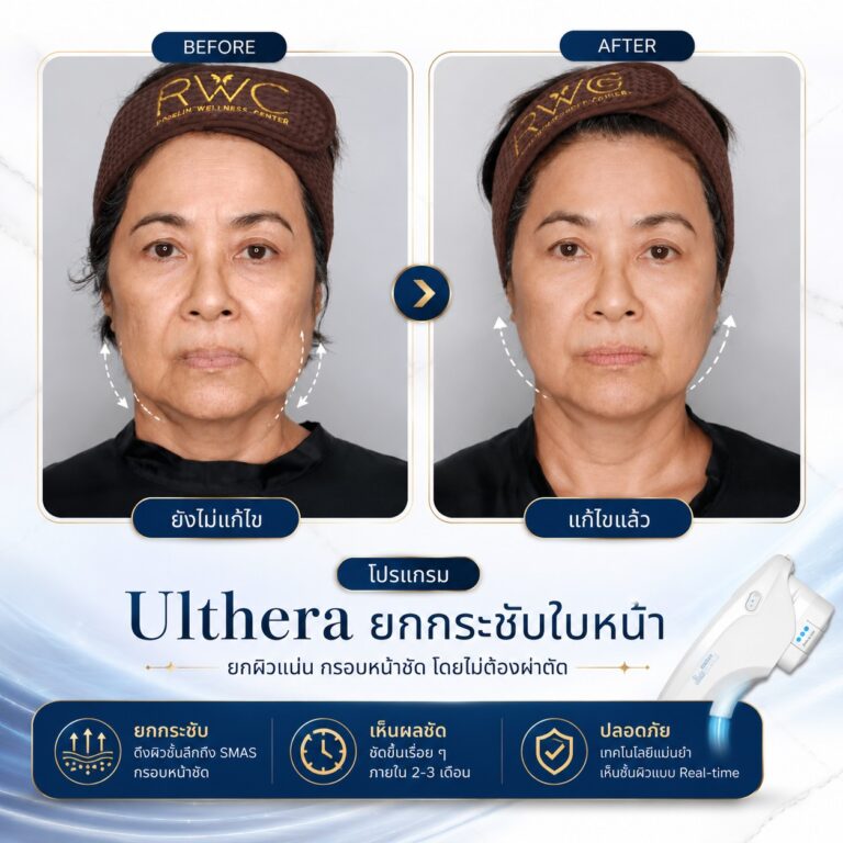 รีวิวผลลัพธ์ Ulthera
