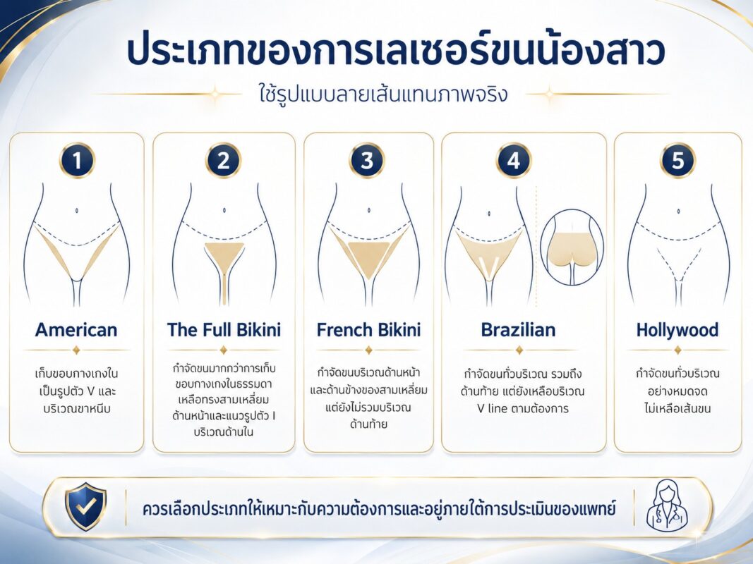 ประเภทของการเลเซอร์ขนน้องสาว