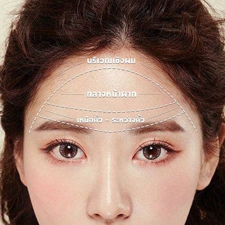 ฉีดฟิลเลอร์หน้าผาก กี่ซีซี