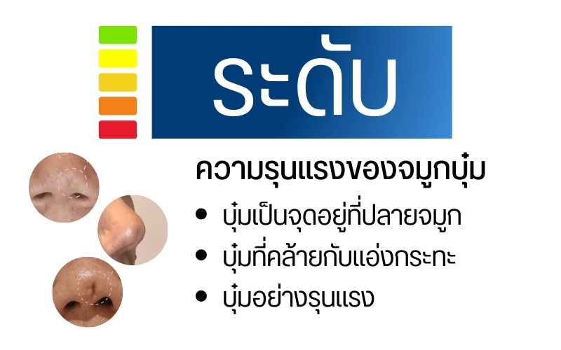 ระดับความรุนแรงของจมูกบุ๋ม