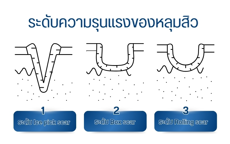 ระดับความรุนแรงของหลุมสิว