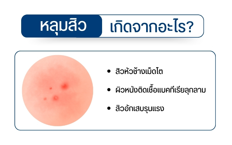 หลุมสิวเกิดจากอะไร?