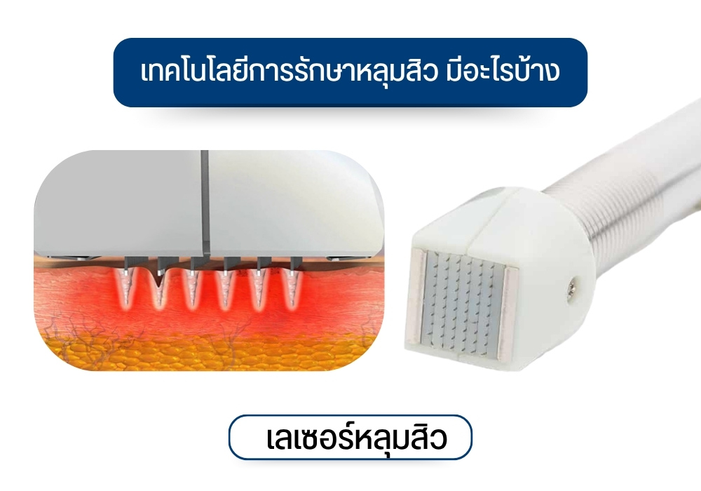 เลเซอร์หลุมสิว