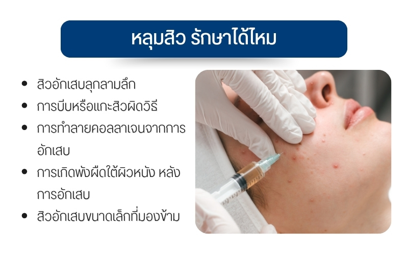 หลุมสิว รักษาได้ไหม