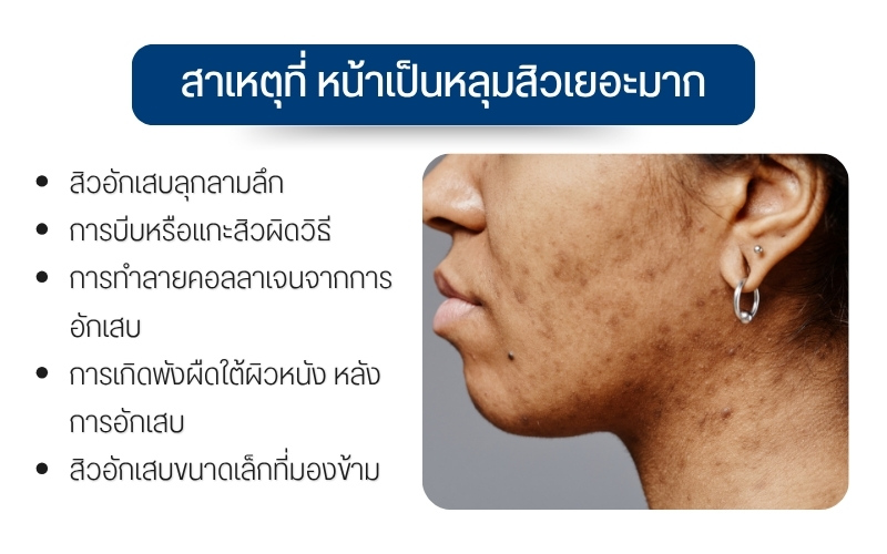 สาเหตุที่ หน้าเป็นหลุมสิวเยอะมาก