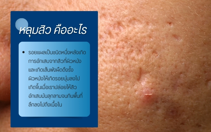 หลุมสิว คืออะไร