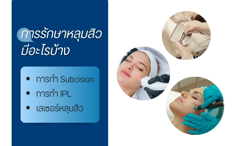 การรักษาหลุมสิว มีอะไรบ้าง