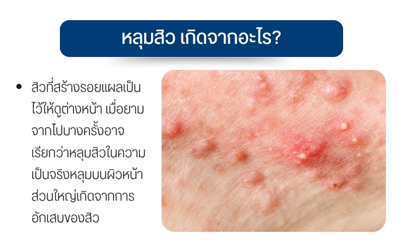 หลุมสิว เกิดจากอะไร