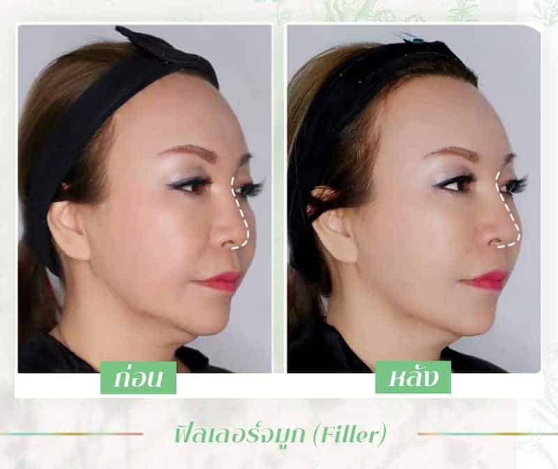 ฉีดฟิลเลอร์จมูก
