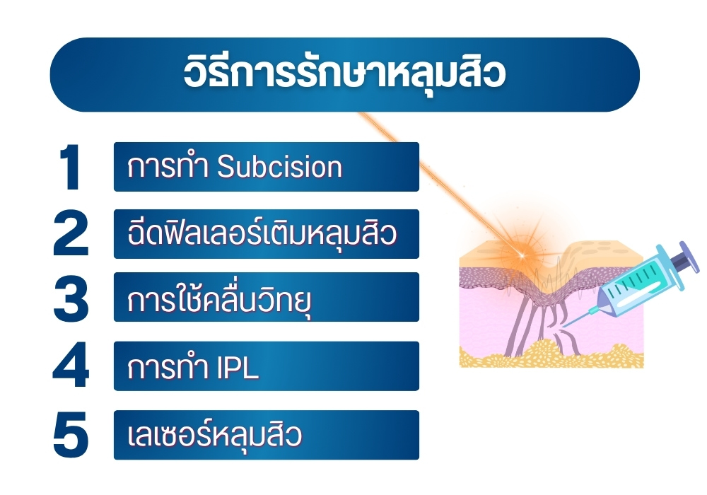 วิธีการรักษาหลุมสิว
