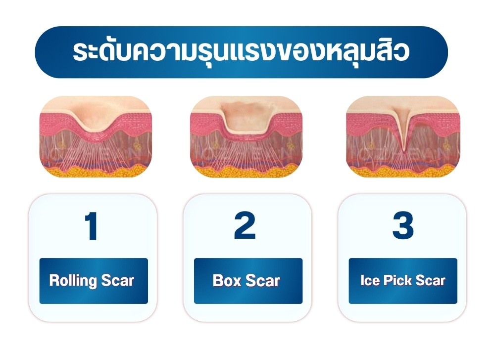 ระดับความรุนแรงของหลุมสิว