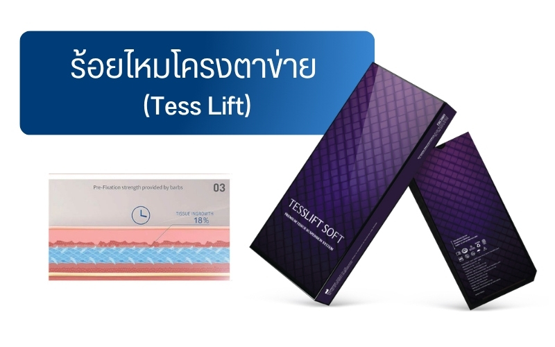 ร้อยไหมโครงตาข่าย (Tess Lift)