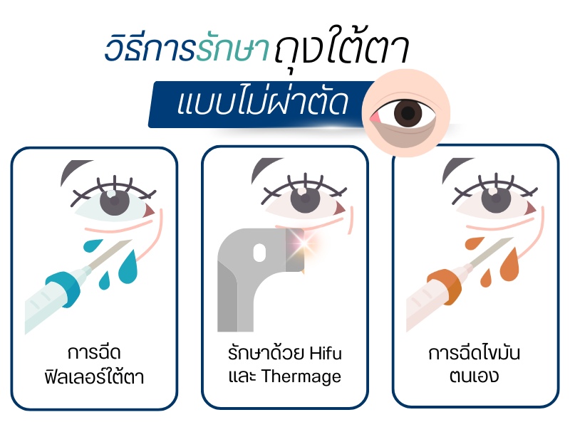 วิธีการรักษาถุงใต้ตาแบบไม่ผ่าตัด