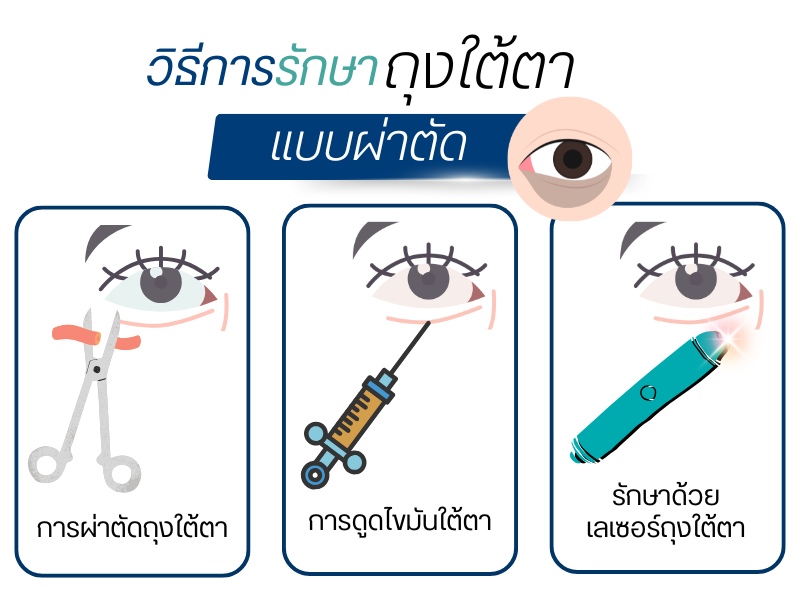 วิธีการรักษาถุงใต้ตาแบบผ่าตัด