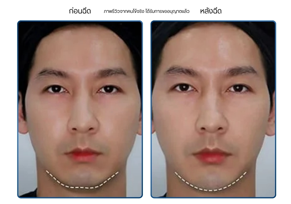 รีวิว ฉีดคาง ก่อน-หลัง