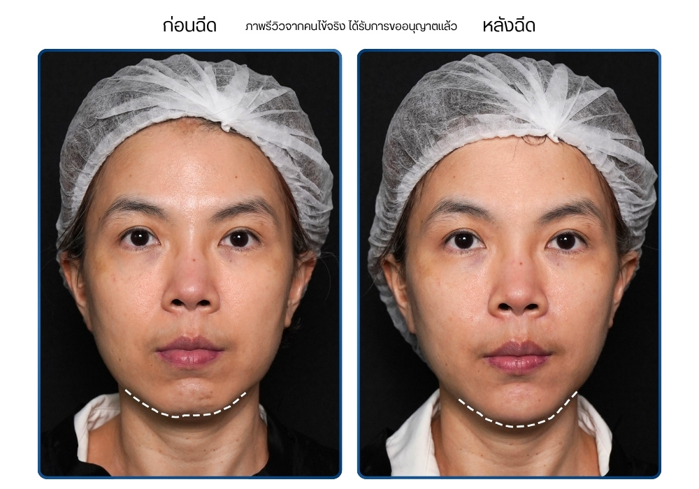 รีวิวฉีดฟิลเลอร์คาง ก่อน-หลัง